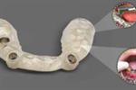 3D printing produces surgical guides with digital precision